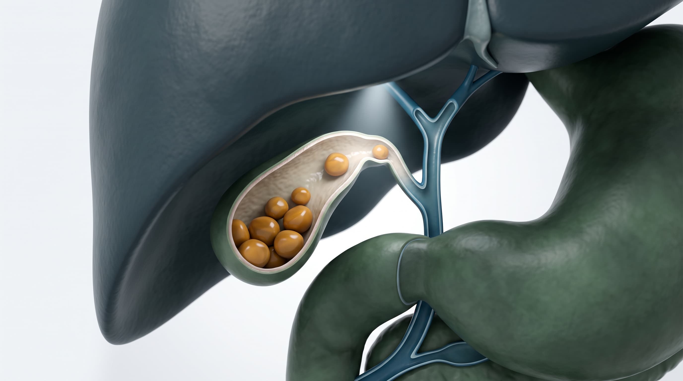 Patología de la Vesícula Biliar y Colelitiasis