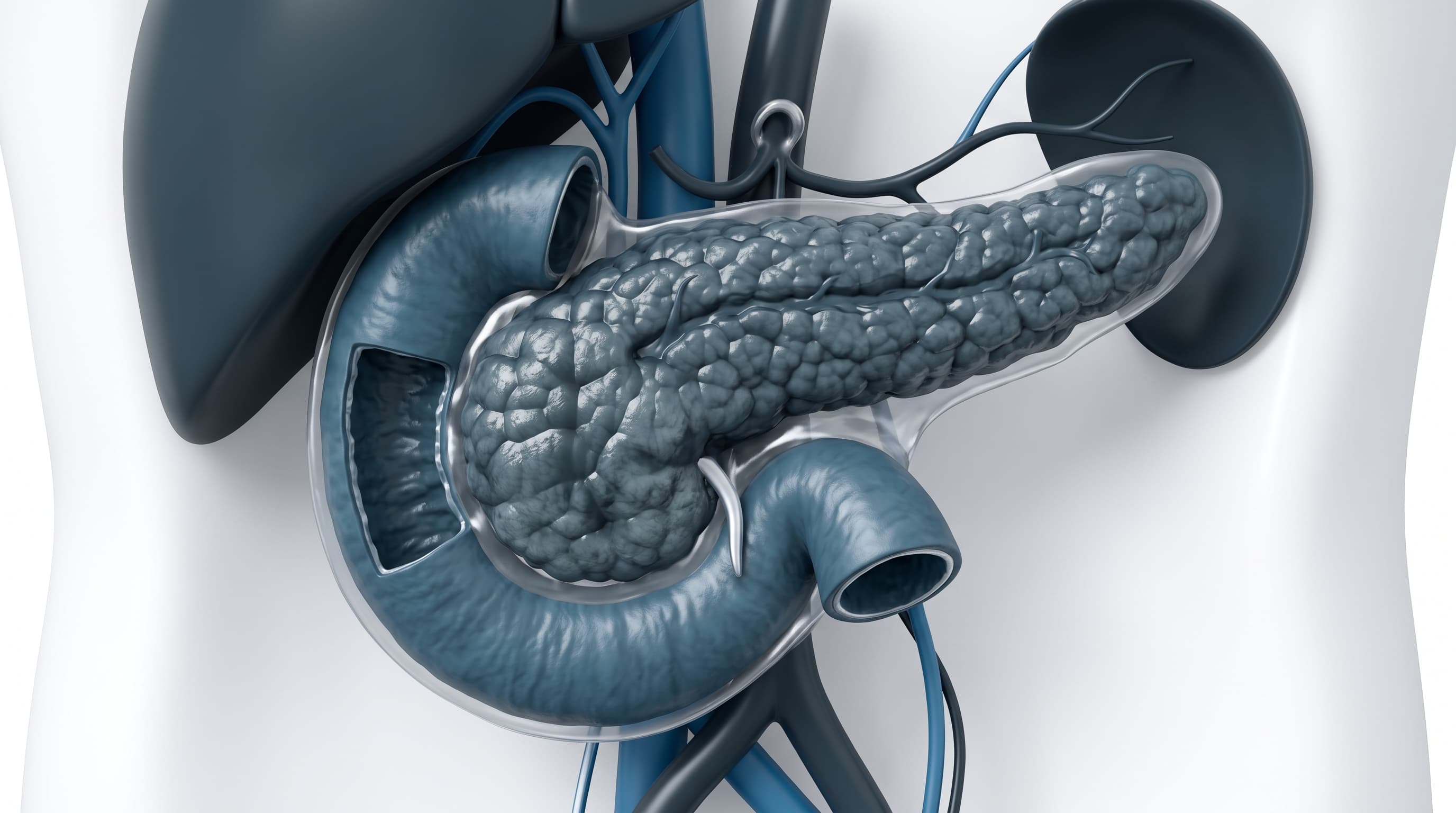 Pancreatitis Aguda Biliar y Metabólica