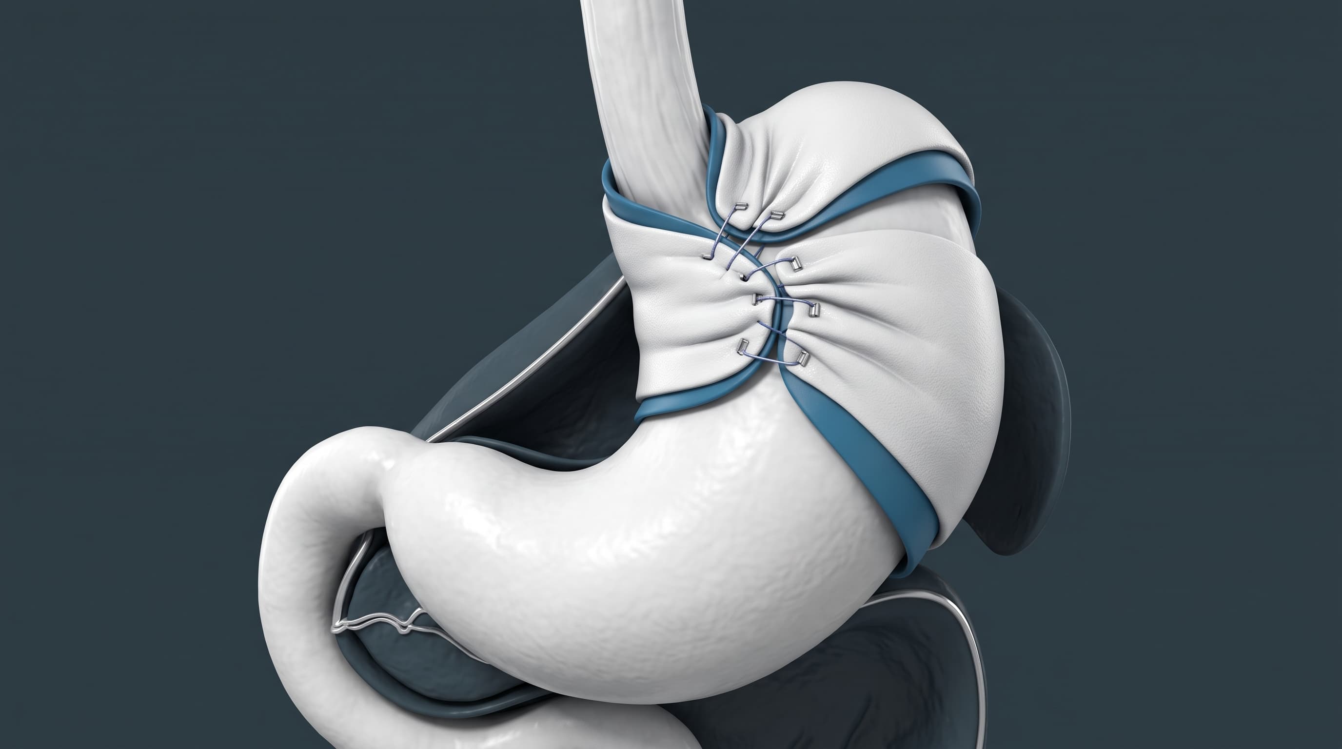 Funduplicatura Laparoscópica (Reflujo y Hernia Hiatal)