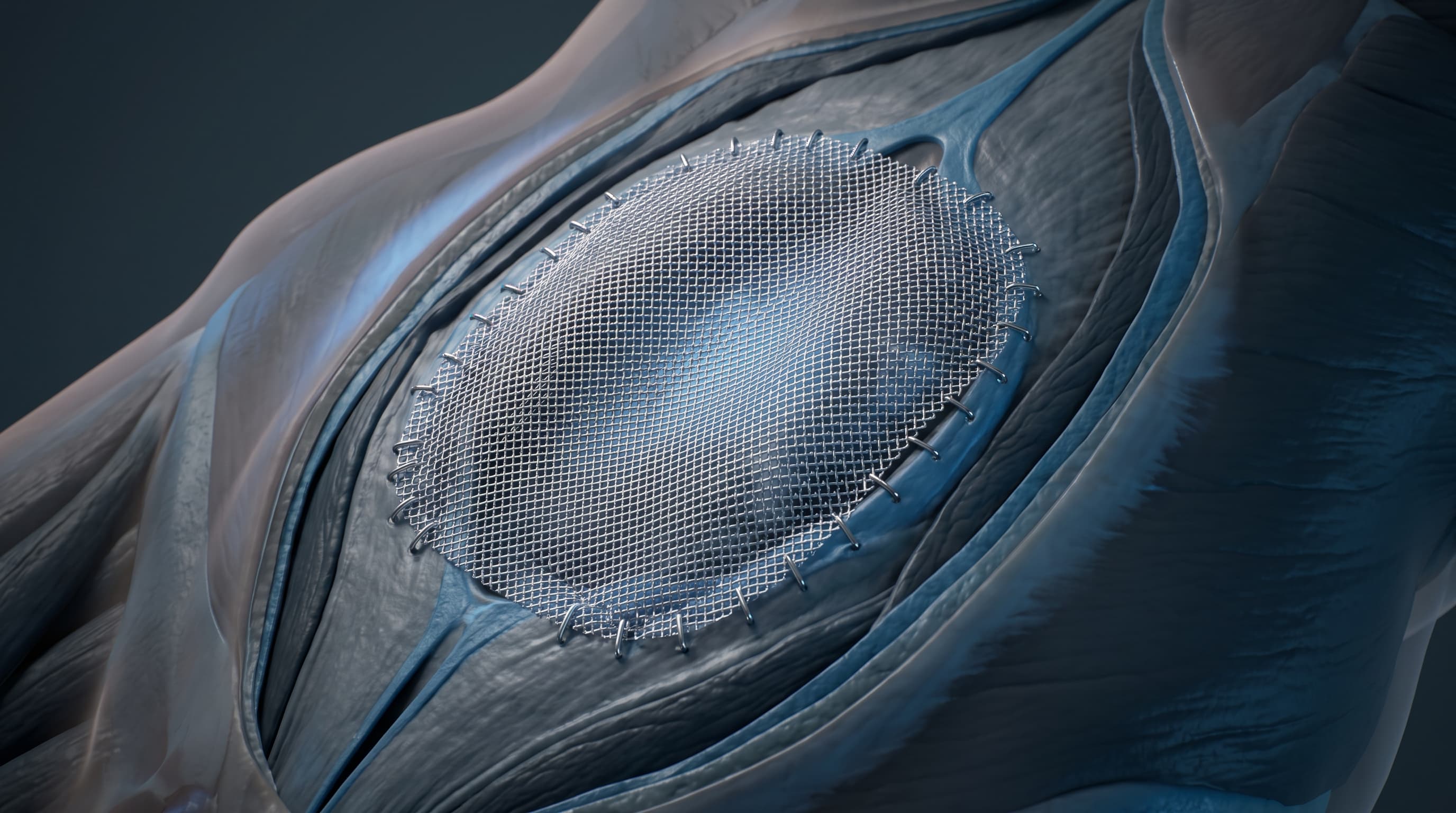 Plastía Umbilical y Epigástrica con Malla